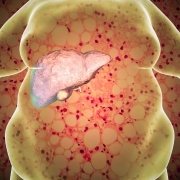 karaciğer-yağlanmasında-diyet